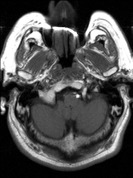 File:Cerebellopontine angle meningioma (Radiopaedia 24459-24764 Axial T1 2).jpg