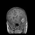 Cerebral abscess post cardiac surgery (Radiopaedia 27244-27420 Coronal T1 C+ 6).jpg