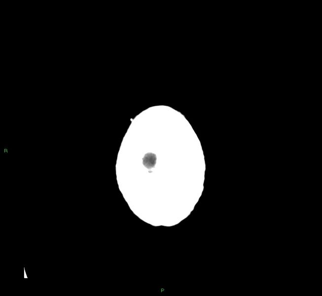 File:Cerebral amyloid angiopathy-associated lobar intracerebral hemorrhage (Radiopaedia 58376-65511 Axial non-contrast 5).jpg