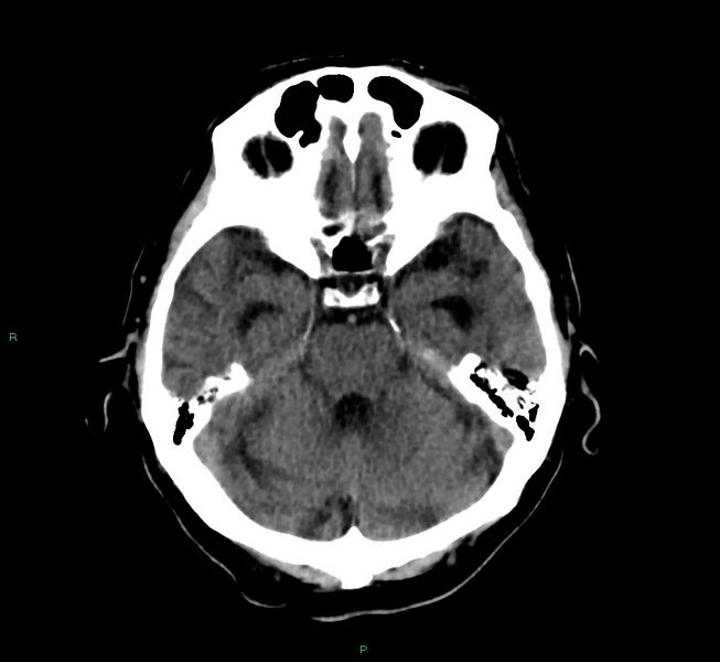 File:Cerebral amyloid angiopathy-associated lobar intracerebral hemorrhage (Radiopaedia 58376-65513 Axial non-contrast 36).jpg