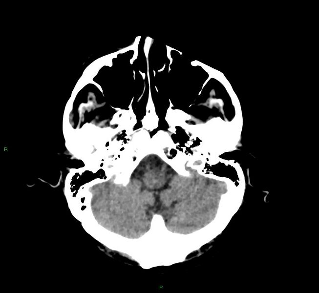 File:Cerebral amyloid angiopathy-associated lobar intracerebral hemorrhage (Radiopaedia 58530-65688 Axial non-contrast 42).jpg