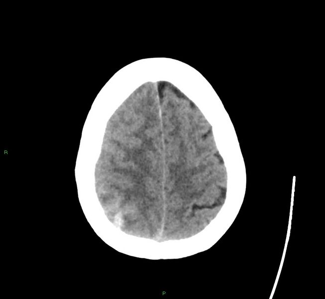 File:Cerebral amyloid angiopathy-associated lobar intracerebral hemorrhage (Radiopaedia 58563-65727 Axial non-contrast 14).jpg