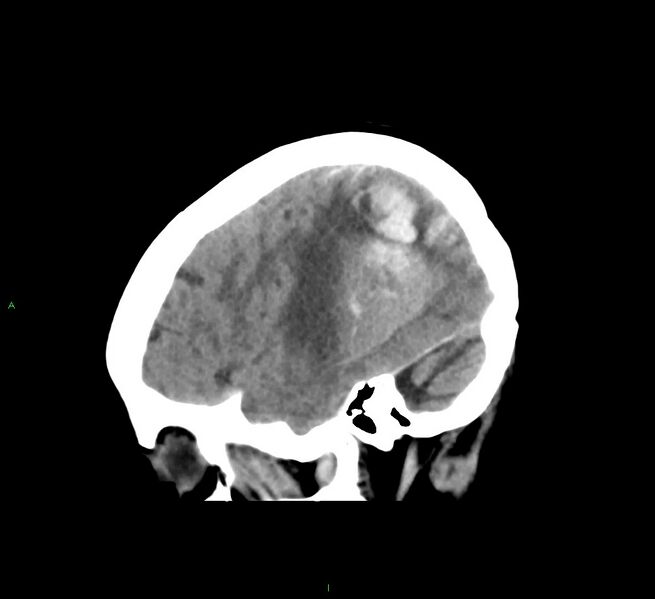 File:Cerebral amyloid angiopathy-associated lobar intracerebral hemorrhage (Radiopaedia 58563-65727 C 14).jpg