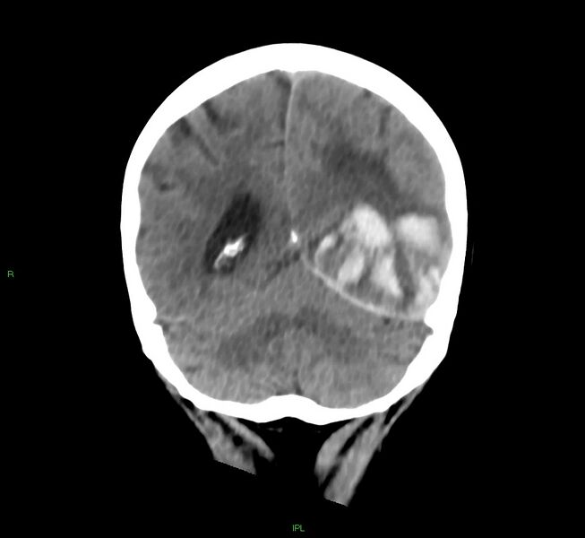 File:Cerebral amyloid angiopathy-associated lobar intracerebral hemorrhage (Radiopaedia 58754-65975 Coronal non-contrast 22).jpg