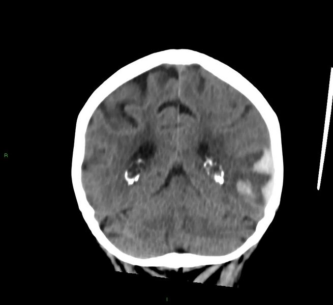 File:Cerebral amyloid angiopathy-associated lobar intracerebral hemorrhage (Radiopaedia 58757-65978 Coronal non-contrast 23).jpg