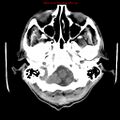 Cerebral and orbital tuberculomas (Radiopaedia 13308-13310 Axial non-contrast 4).jpg