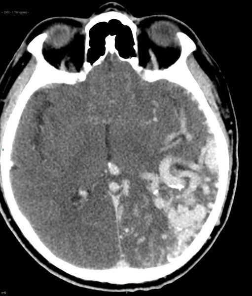 File:Cerebral arteriovenous malformation (Radiopaedia 40528-43125 C 1).jpg