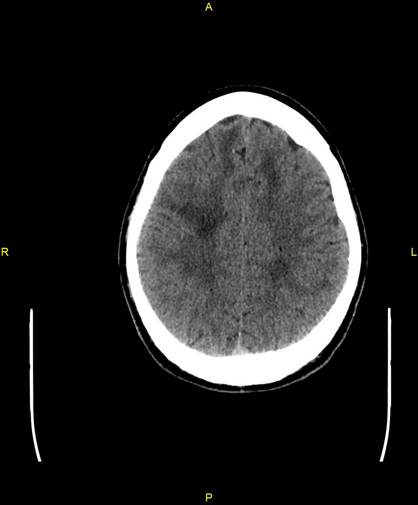 Cerebral autosomal dominant arteriopathy with subcortical infarcts and leukoencephalopathy (CADASIL) (Radiopaedia 86108-102051 Axial non-contrast 82).jpg