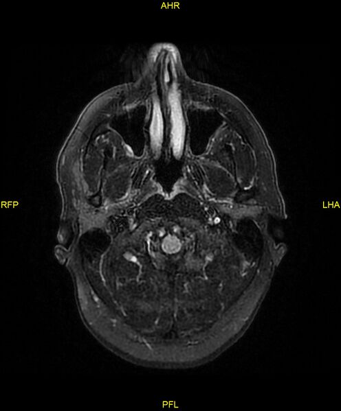 File:Cerebral autosomal dominant arteriopathy with subcortical infarcts and leukoencephalopathy (CADASIL) (Radiopaedia 86108-102054 Axial FLAIR 3).jpg