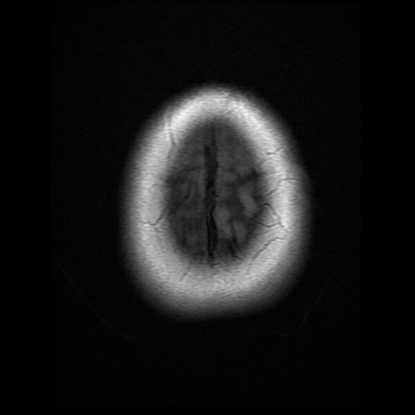 File:Cerebral cavernous malformation (Radiopaedia 44301-47942 Axial T1 20).jpg