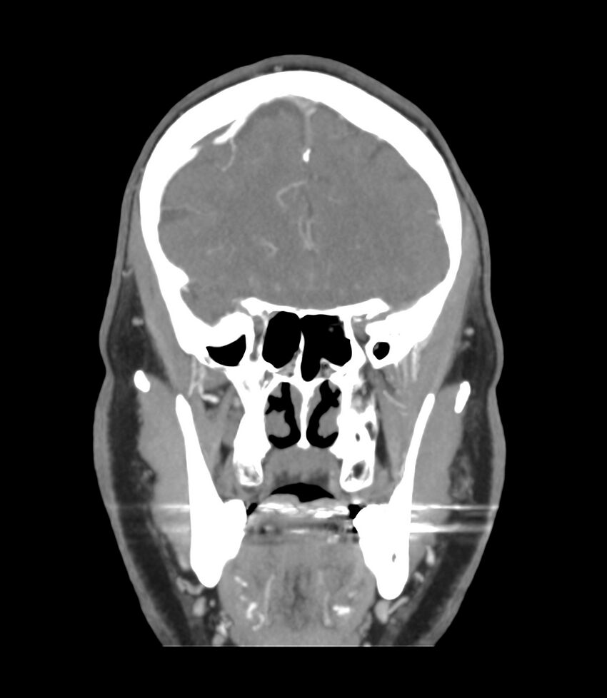 Cerebral dural venous sinus thrombosis (Radiopaedia 86514-102576 B 16).jpg