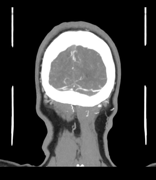 File:Cerebral dural venous sinus thrombosis (Radiopaedia 86514-102576 B 72).jpg