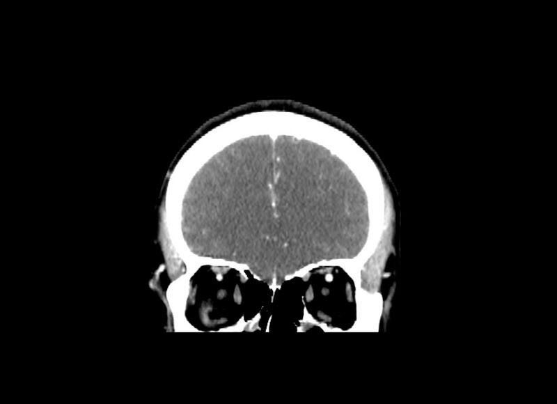 File:Cerebral edema (Radiopaedia 82519-96661 C 49).jpg