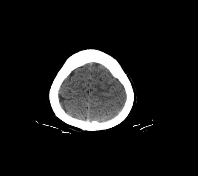File:Cerebral fat embolism (Radiopaedia 37510-39362 Axial non-contrast 29).jpg
