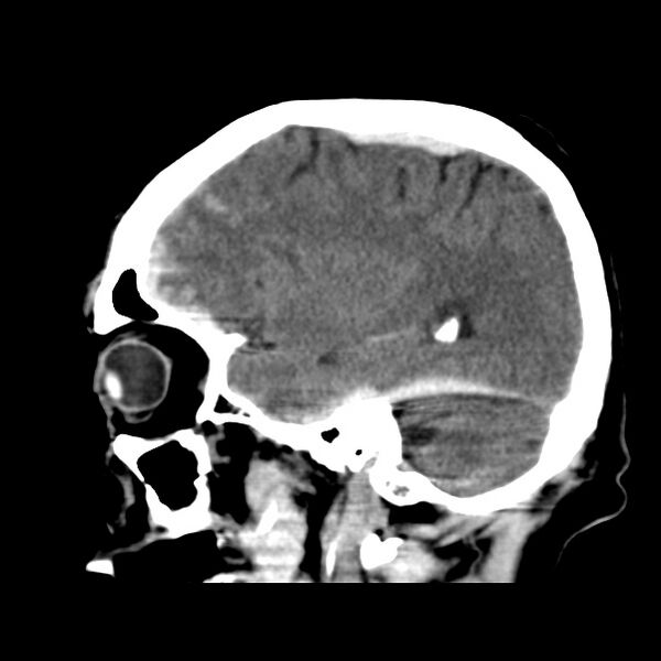 File:Cerebral hemorrhagic contusions (Radiopaedia 23145-23188 C 13).jpg