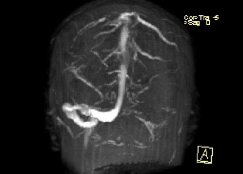 File:Cerebral venous infarct (Radiopaedia 53627-59723 3D MRV 9).jpg