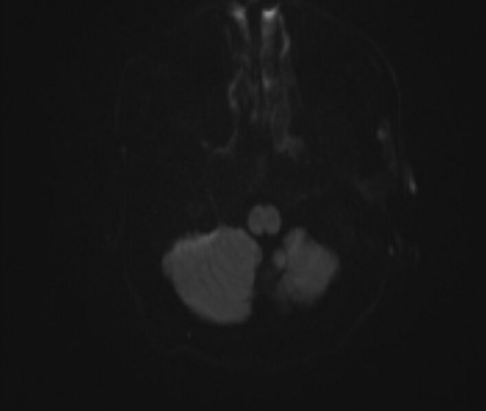 File:Cerebral venous thrombosis (Radiopaedia 71207-81504 Axial DWI 2).jpg