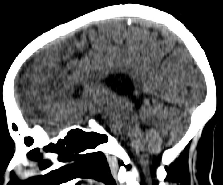 File:Cerebral venous thrombosis - CT only (Radiopaedia 41031-43778 B 15).jpg