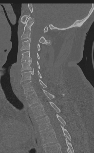 File:Cervical canal stenosis due to ossification of the posterior longitudinal ligament (Radiopaedia 47260-51823 Sagittal bone window 34).png