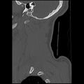 Cervical flexion teardrop fracture with cord hemorrhage (Radiopaedia 32497-33454 Sagittal bone window 1).jpg