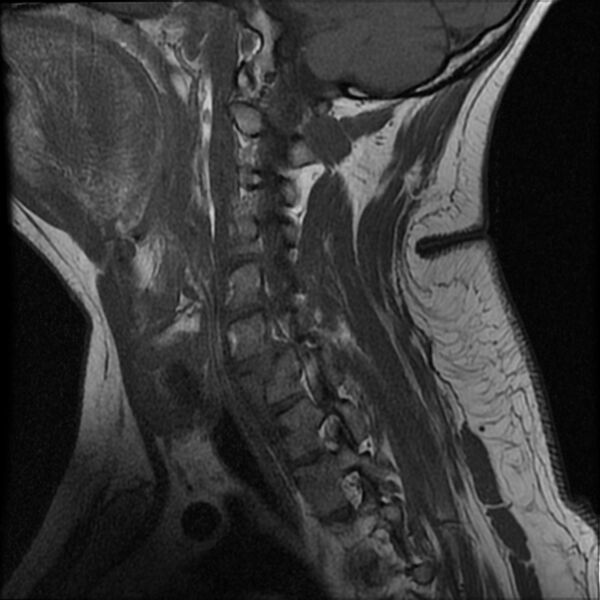 File:Cervical fracture and dislocation with locked facet (Radiopaedia 31837-32781 Sagittal T1 4).jpg