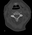Cervical spine ACDF loosening (Radiopaedia 48998-54070 Axial bone window 23).png
