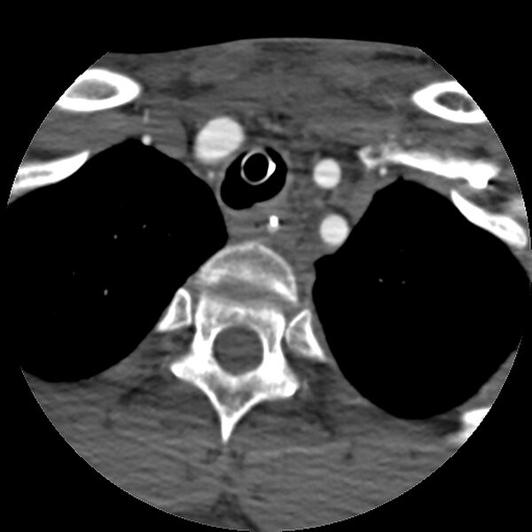 File:Cervical spine fractures with vertebral artery dissection (Radiopaedia 32135-33078 D 12).jpg