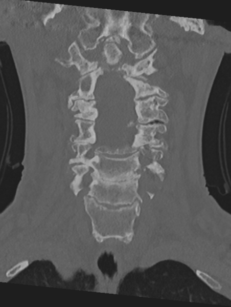 File:Cervical spondylolysis (Radiopaedia 49616-54811 Coronal bone window 20).png
