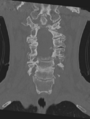 Cervical spondylolysis (Radiopaedia 49616-54811 Coronal bone window 20).png