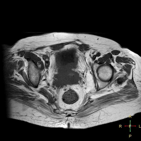 File:Cervical stump squamous cell carcinoma (Radiopaedia 48049-52858 Axial T1 9).jpg