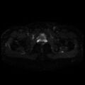 Cesarian section scar endometriosis (Radiopaedia 66520-75799 Axial DWI 22).jpg