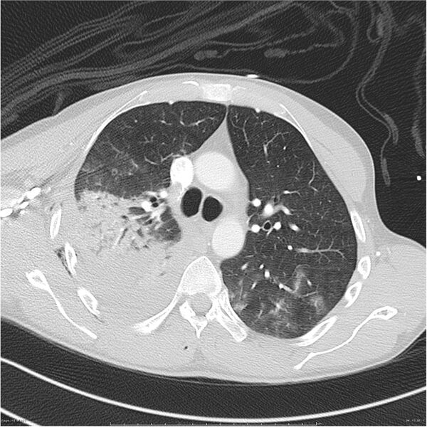 File:Chest and abdomen multi-trauma (Radiopaedia 26294-26425 lung window 41).jpg
