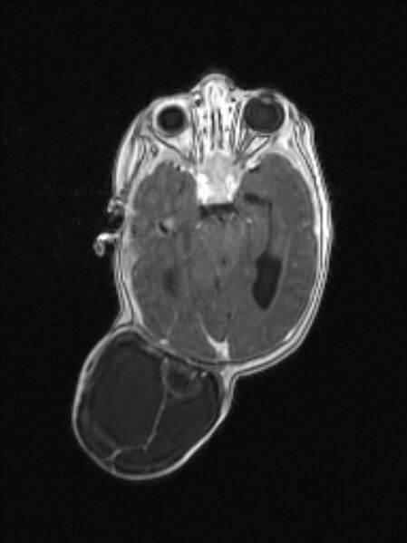 File:Chiari III malformation with occipital encephalocele (Radiopaedia 79446-92559 Axial T1 C+ mpr 42).jpg