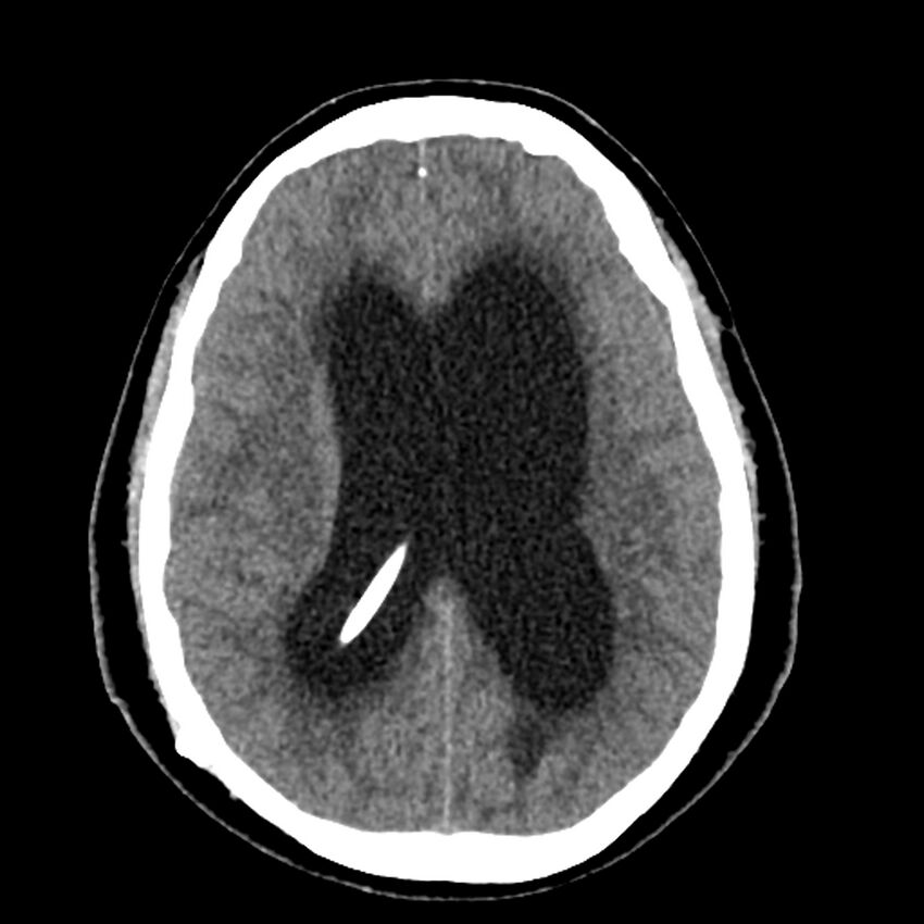 Chiasmatic-hypothalamic juvenile pilocytic astrocytoma (Radiopaedia 78533-91237 Axial non-contrast 36).jpg