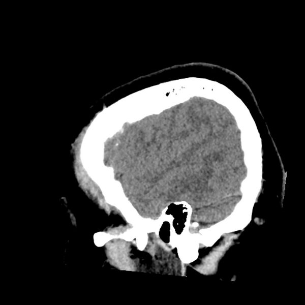 File:Chiasmatic-hypothalamic juvenile pilocytic astrocytoma (Radiopaedia 78533-91237 B 14).jpg