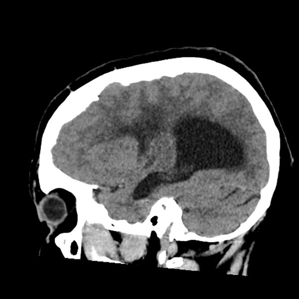 File:Chiasmatic-hypothalamic juvenile pilocytic astrocytoma (Radiopaedia 78533-91237 B 21).jpg