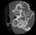 Cholesteatoma (Radiopaedia 20296-20217 bone window 16).jpg