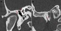 Chorda tympani (Radiopaedia 25948-26089 Sagittal bone window 1).jpg
