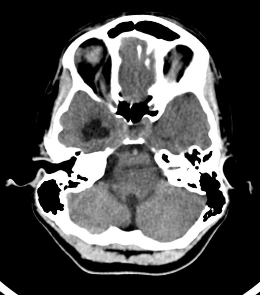 File:Choroid plexus carcinoma (Radiopaedia 91013-108552 Axial non-contrast 16).jpg