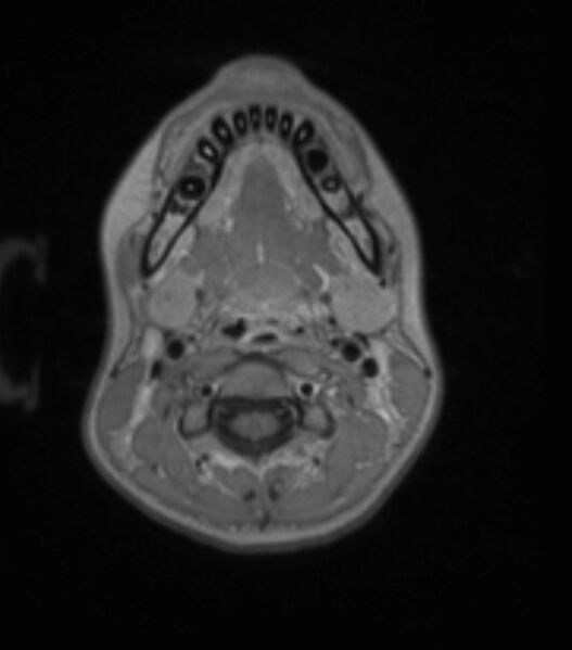 File:Choroid plexus carcinoma (Radiopaedia 91013-108553 Axial T1 C+ 28).jpg