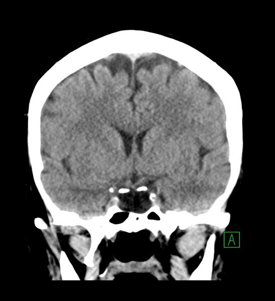 File:Choroid plexus xanthogranuloma (Radiopaedia 91271-108874 Coronal non-contrast 15).jpg