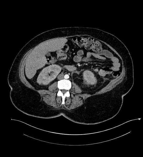 File:Chromophobe renal cell carcinoma (Radiopaedia 84239-99519 B 66).jpg