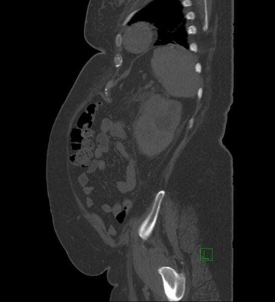 File:Chromophobe renal cell carcinoma (Radiopaedia 84239-99519 Sagittal bone window 20).jpg