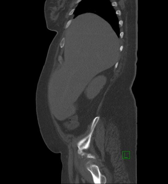 File:Chromophobe renal cell carcinoma (Radiopaedia 84239-99519 Sagittal bone window 88).jpg