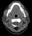 Chronic Submandibular sialolithiasis (Radiopaedia 16880-16606 Axial non-contrast 10).jpg