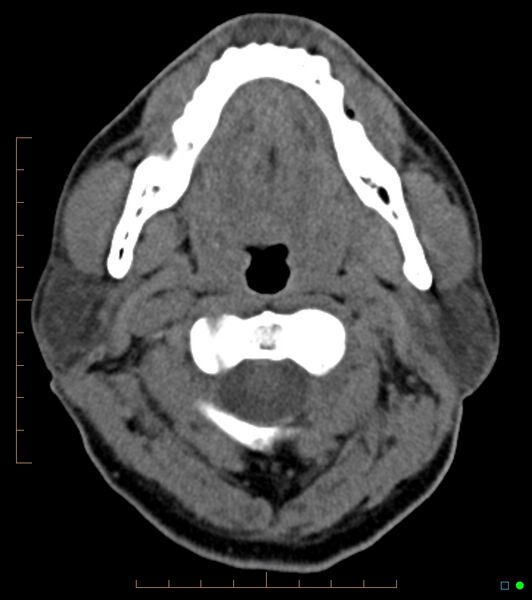 File:Chronic Submandibular sialolithiasis (Radiopaedia 16880-16606 Axial non-contrast 10).jpg