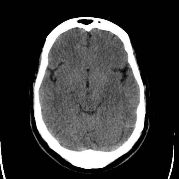 File:Chronic bilateral occipital lobe infarcts (Radiopaedia 31276-31996 Axial non-contrast 17).jpg