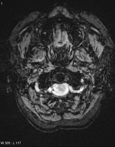 File:Chronic lymphocytic inflammation with pontine perivascular enhancement responsive to steroids (CLIPPERS) (Radiopaedia 37520-39374 Axial SWI 72).jpg