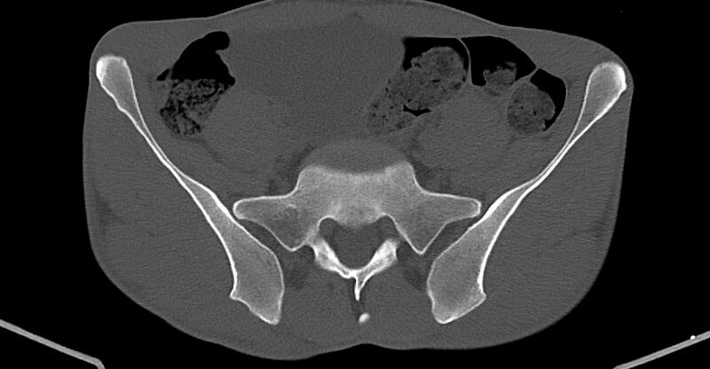 File:Chronic osteomyelitis (with sequestrum) (Radiopaedia 74813-85822 Axial non-contrast 3).jpg
