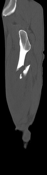 File:Chronic osteomyelitis (with sequestrum) (Radiopaedia 74813-85822 C 93).jpg